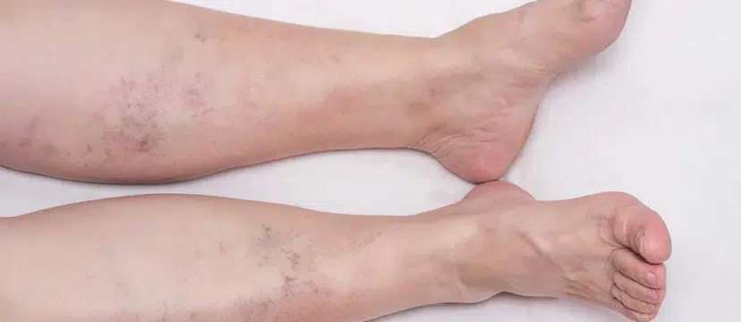 Venous Insufficiency