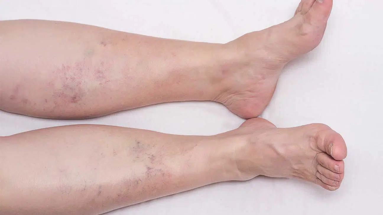 Venous Insufficiency From IV Drug Use - Opioid Treatment
