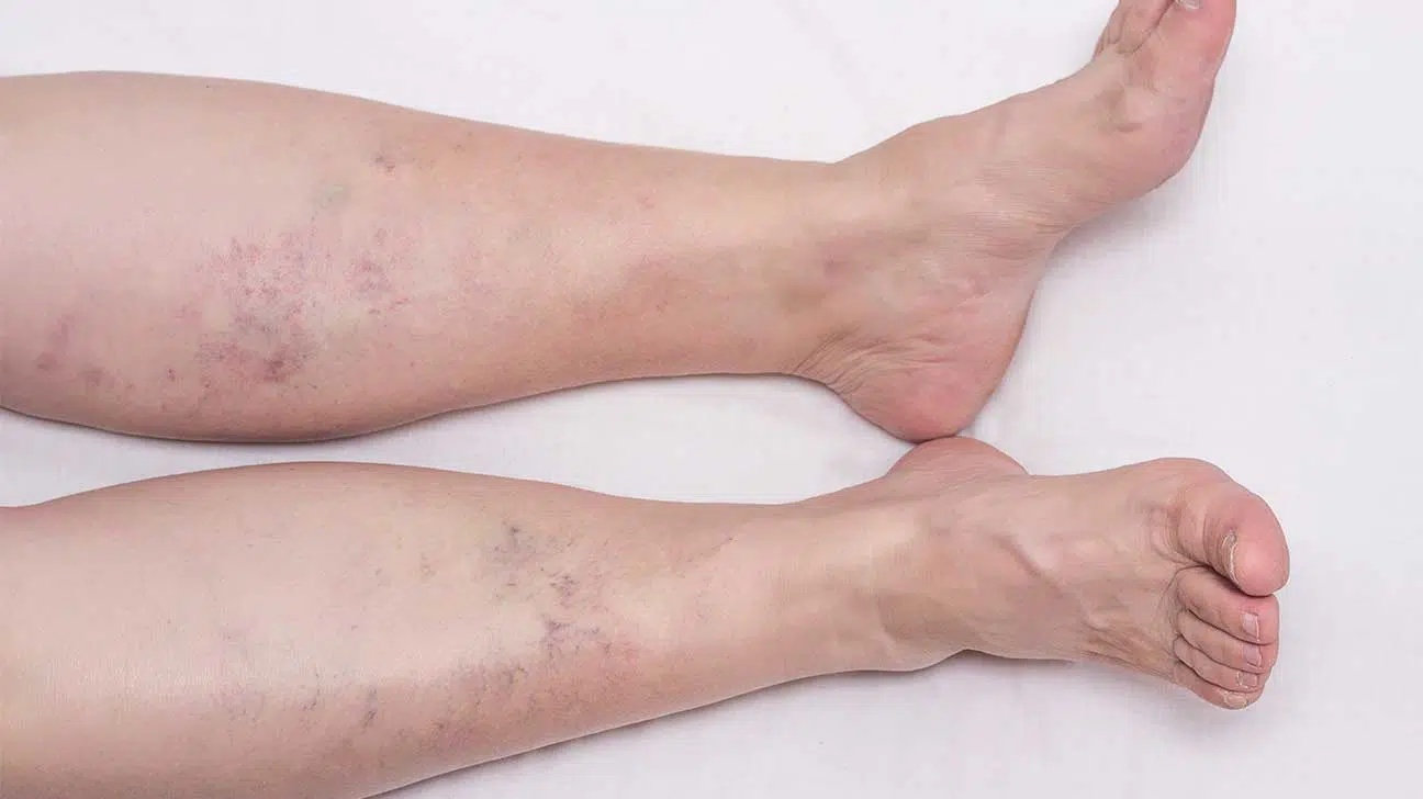 Venous Insufficiency